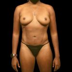 Liposuction Before & After Patient #434