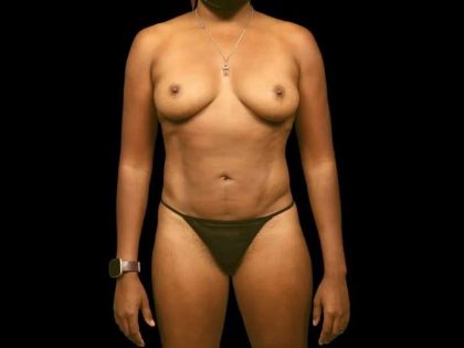 Liposuction Before & After Patient #434