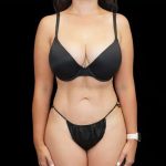 Liposuction Before & After Patient #451
