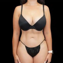 Liposuction Before & After Patient #451