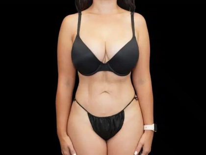 Liposuction Before & After Patient #451