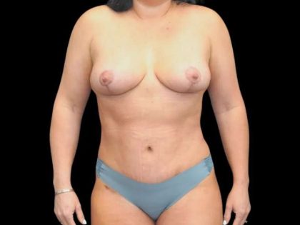 Mommy Makeover Before & After Patient #469