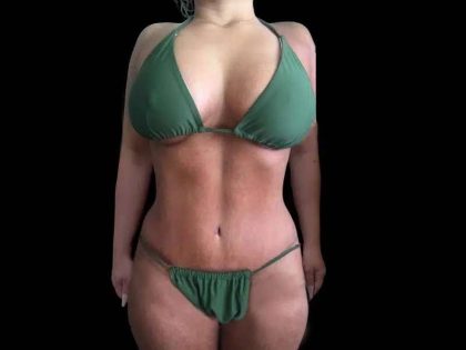 Mommy Makeover Before & After Patient #492