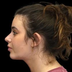 Rhinoplasty Before & After Patient #277