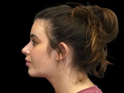 Rhinoplasty Before & After Patient #277