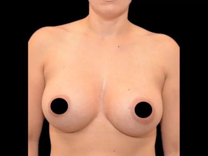 Breast Augmentation Before & After Patient #499