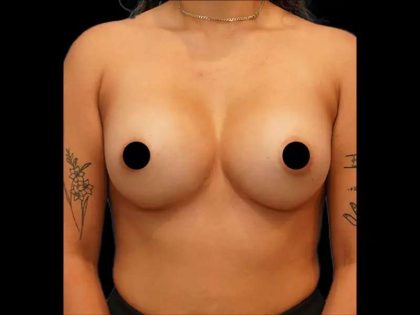 Breast Augmentation Before & After Patient #506