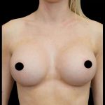 Breast Augmentation Before & After Patient #513