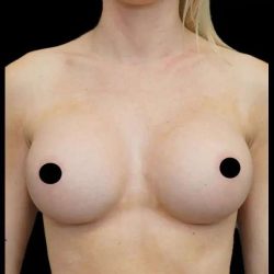 Breast Augmentation Before & After Patient #513