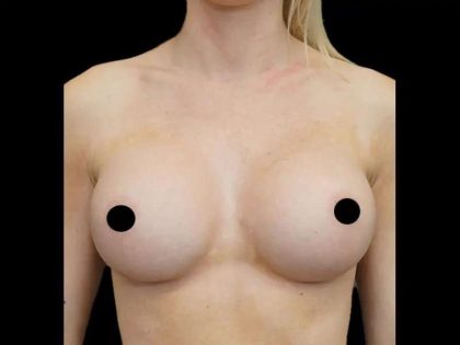Breast Augmentation Before & After Patient #513