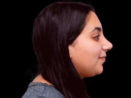 Rhinoplasty Before & After Patient #253