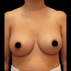 Breast Augmentation Before & After Patient #518