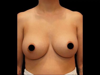 Breast Augmentation Before & After Patient #518