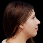 Rhinoplasty Before & After Patient #284