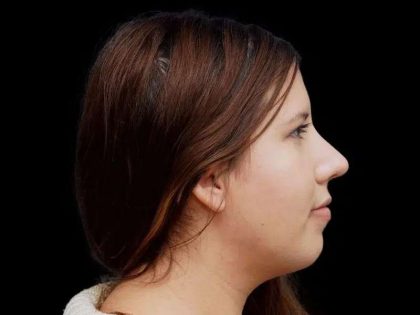 Rhinoplasty Before & After Patient #284