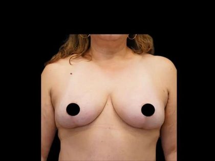 Breast Lift/Reduction Before & After Patient #581