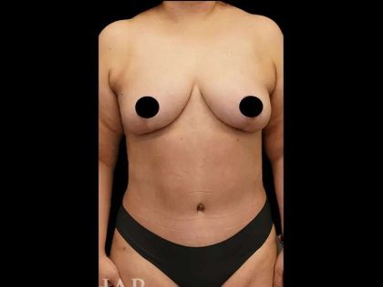Breast Lift/Reduction Before & After Patient #587