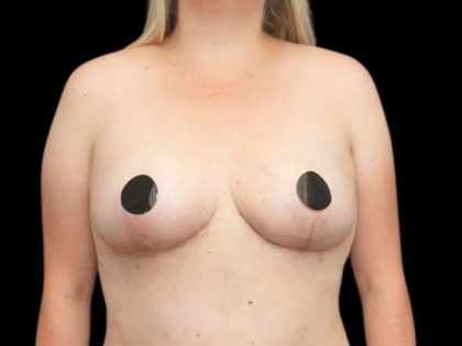 Breast Reduction Before & After Patient #594