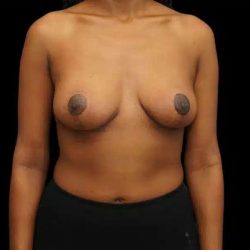 Breast Lift Before & After Patient #601