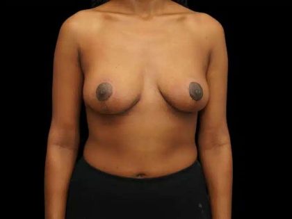 Breast Lift Before & After Patient #601