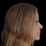 Rhinoplasty Before & After Patient #291
