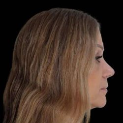 Rhinoplasty Before & After Patient #291