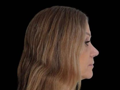 Rhinoplasty Before & After Patient #291
