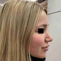 Rhinoplasty Before & After Patient #296