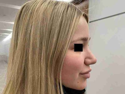 Rhinoplasty Before & After Patient #296