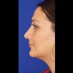 Rhinoplasty Before & After Patient #299