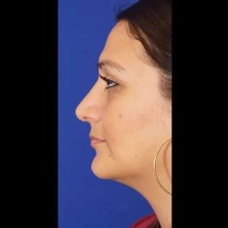 Rhinoplasty Before & After Patient #299