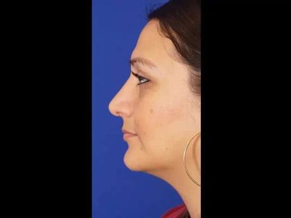 Rhinoplasty Before & After Patient #299