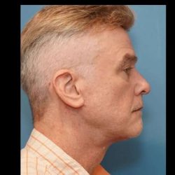 Necklift Before & After Patient #304