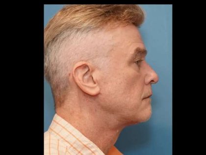Necklift Before & After Patient #304