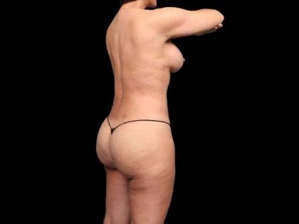 Brazilian Butt Lift Before & After Patient #335