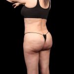 Brazilian Butt Lift Before & After Patient #350