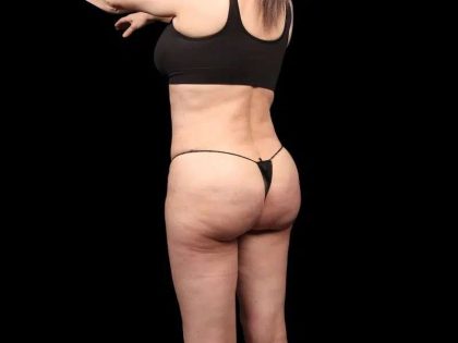 Brazilian Butt Lift Before & After Patient #350