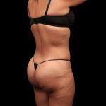 Brazilian Butt Lift Before & After Patient #355