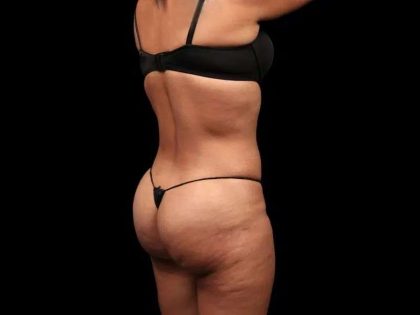 Brazilian Butt Lift Before & After Patient #355