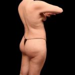 Brazilian Butt Lift Before & After Patient #362