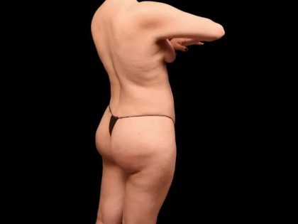 Brazilian Butt Lift Before & After Patient #362