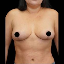 Tummy Tuck Before & After Patient #1554