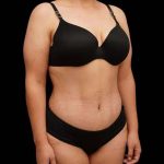 Tummy Tuck Before & After Patient #379
