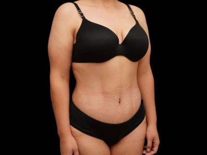 Tummy Tuck Before & After Patient #379