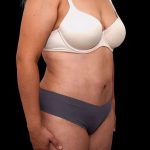 Tummy Tuck Before & After Patient #386