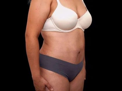 Tummy Tuck Before & After Patient #386