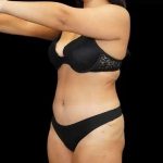 Tummy Tuck Before & After Patient #407