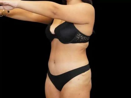 Tummy Tuck Before & After Patient #407