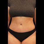 Tummy Tuck Before & After Patient #412