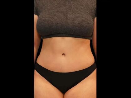 Tummy Tuck Before & After Patient #412